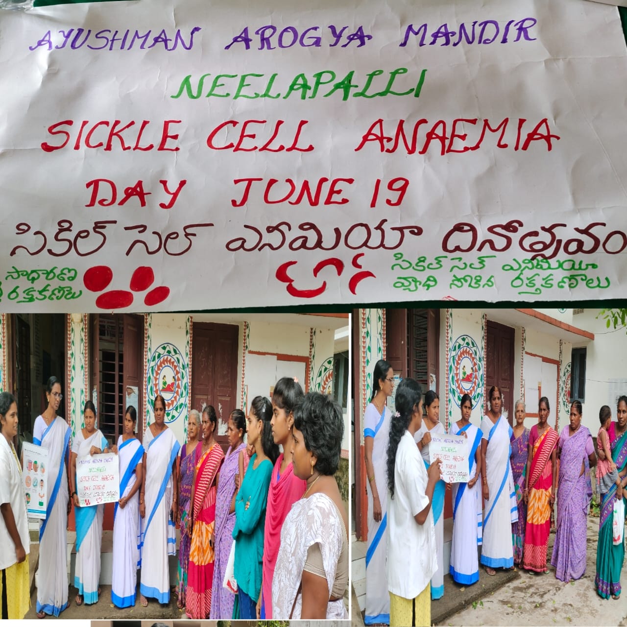 SICKLE CELL ANEMIA